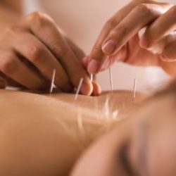 5 benefícios da acupuntura
