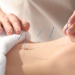 8 problemas que podem ser tratados com acupuntura